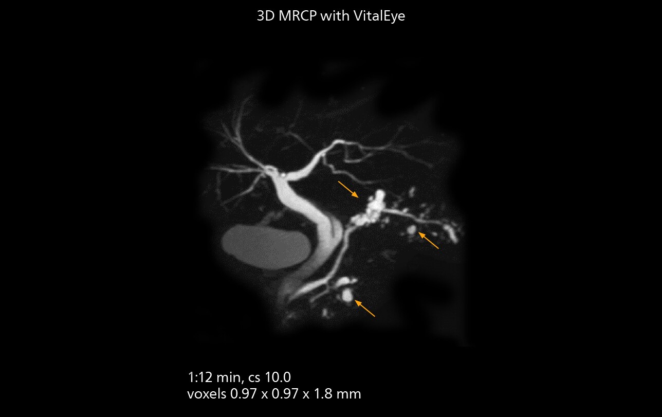 Mrcp mri one