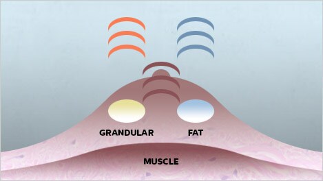 broadband ultrasound