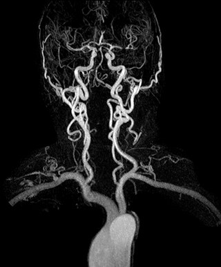 Dynamic MRA of head and neck