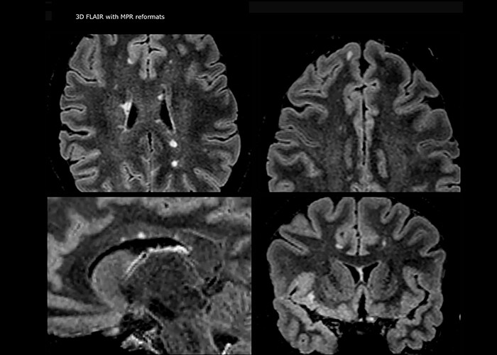 clinical image multiple sclerosis