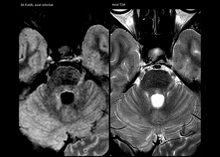 clinical image multiple sclerosis day 2