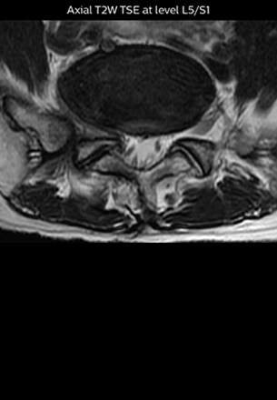 axial t2w tse at level l5/s1