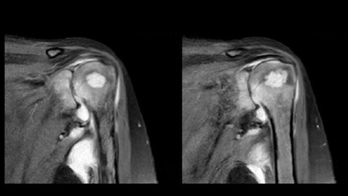 MRI of the shoulder on Ingenia Prodiva 1.5T