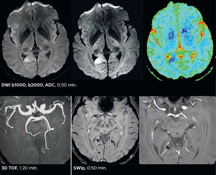 Fast acute stroke protocol A