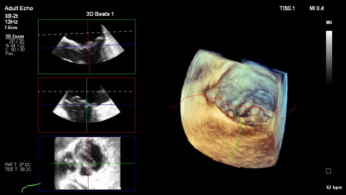 Living in 3d enhance ultrasound guidance