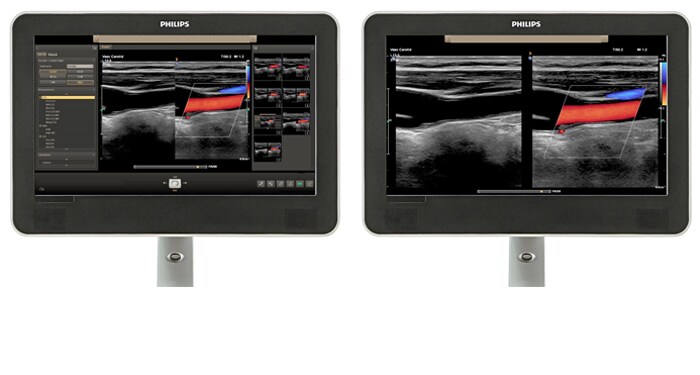 Viewing area comparison with a vascular ultrasound image on screen