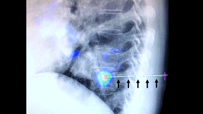 XperGuide and CBCT