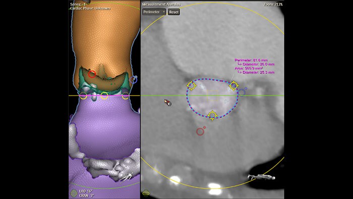 Clinical image Philips HeartNavigator