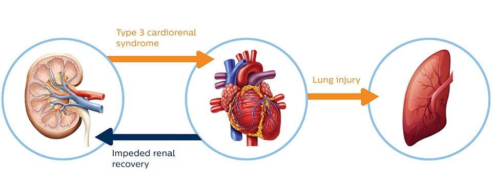 Type 3 cardiorenal syndrome infographic