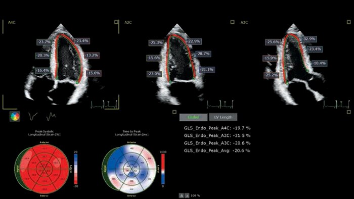 X5 1C Autostrain scan