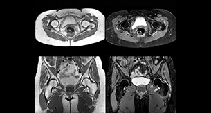 Lefebvre Case Hip MRI thumbnail