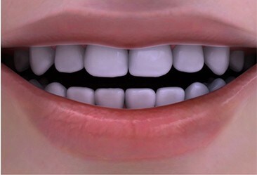 whitening