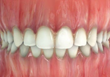 moderate-chronic-gingivitis